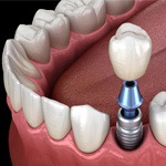 dental implant post being placed in the bottom jaw 