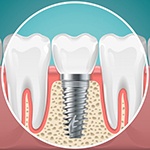 dental implant in the jawbone