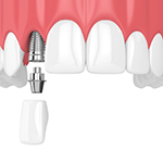 crown being placed over a dental implant 