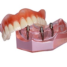 Model of implant denture