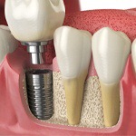 dental implant post being placed in the jaw 