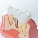 dental implant post in a model of the jaw 