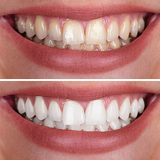 close up smile before and after teeth whitening 
