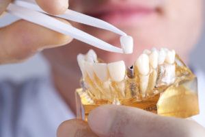 Your dentist makes the best recommendations when discussing dental implants in Pea Ridge. 