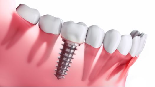 A model of an implant in the lower jaw