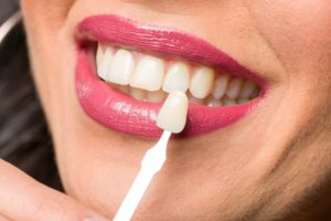 Woman veneer closeup