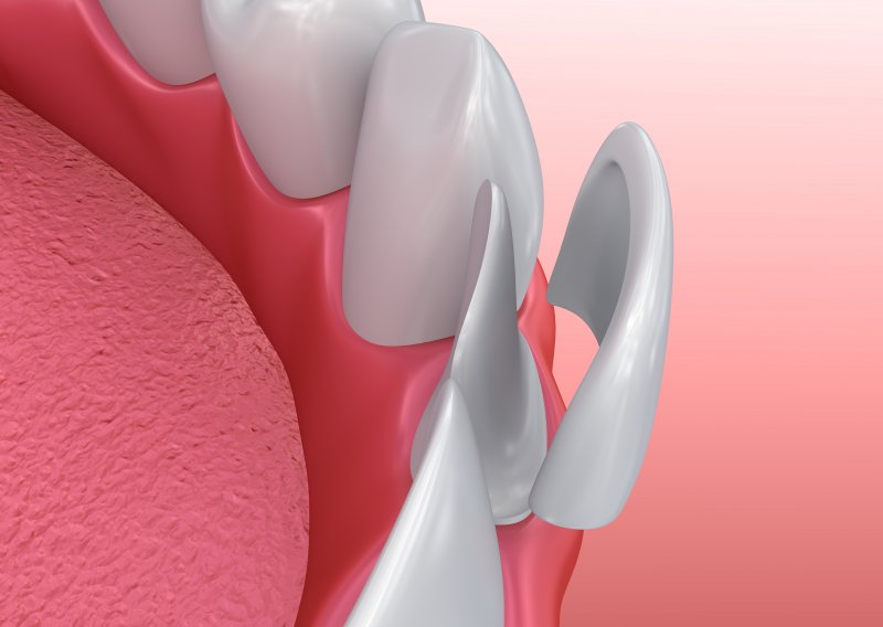 Close-up of 3D rendered porcelain veneer